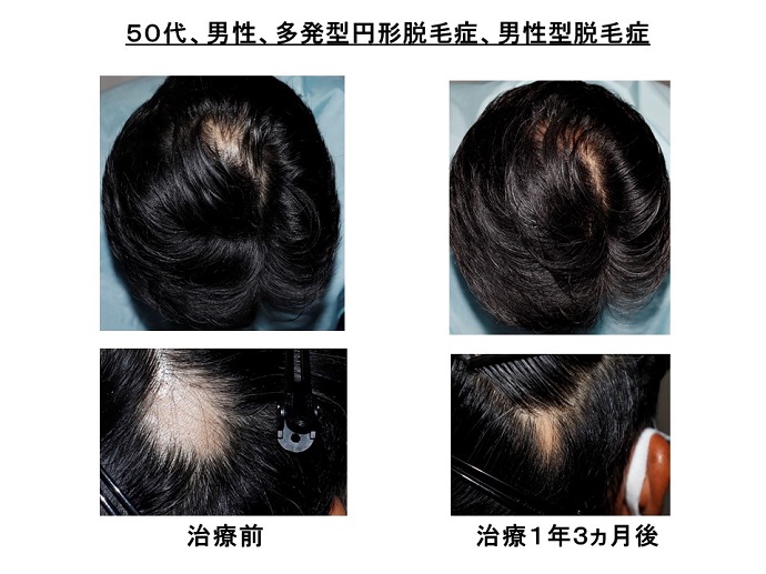 円形脱毛症　病院